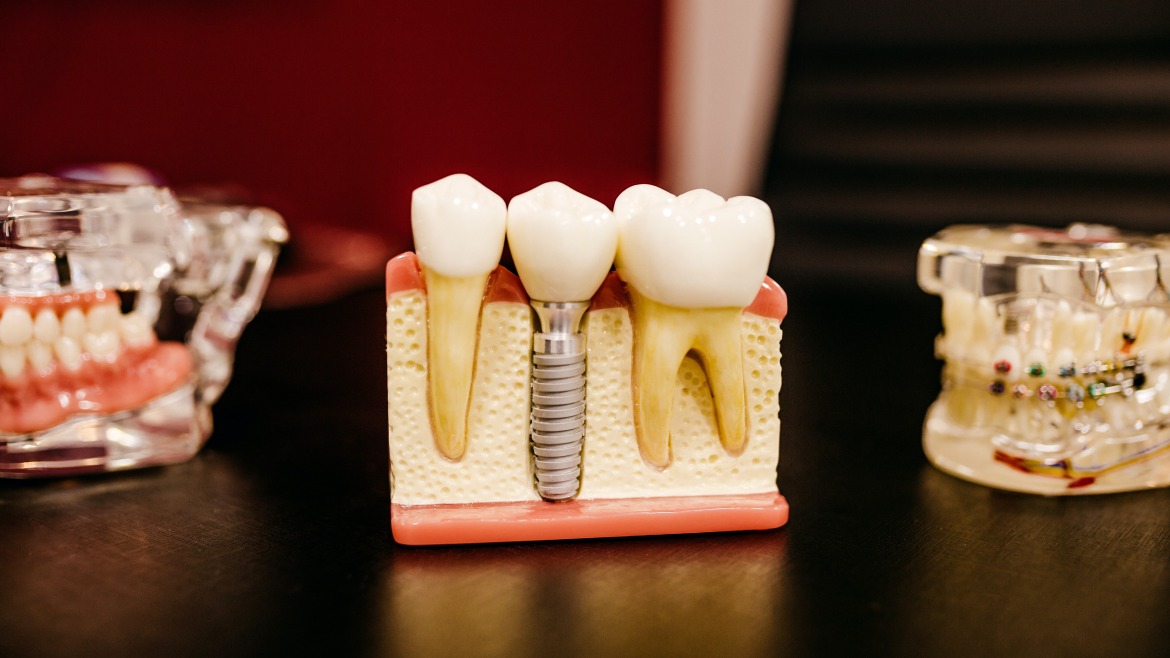 Zubné implantáty
